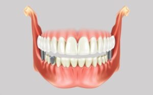 Cost of Full Mouth Dental Implants: What to Expect